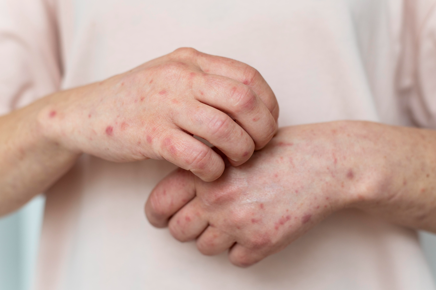 Systemic Lupus Erythematosus Treatment at IRIS