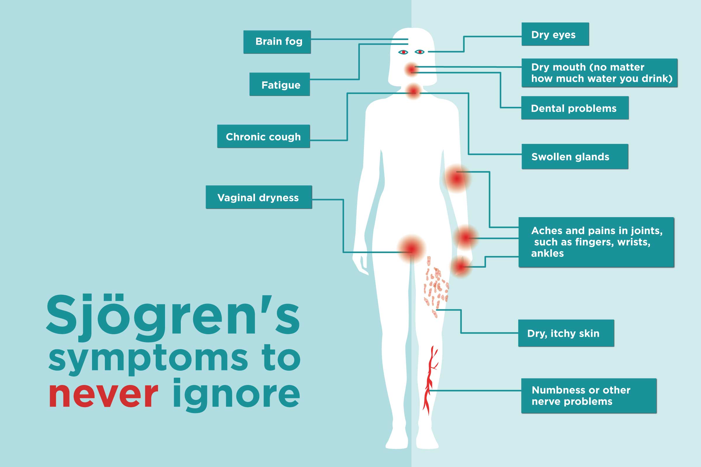 Sjogren's Syndrome Treatment at IRIS