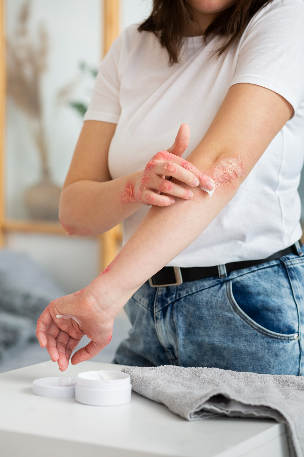 Psoriatic Arthritis Symptoms