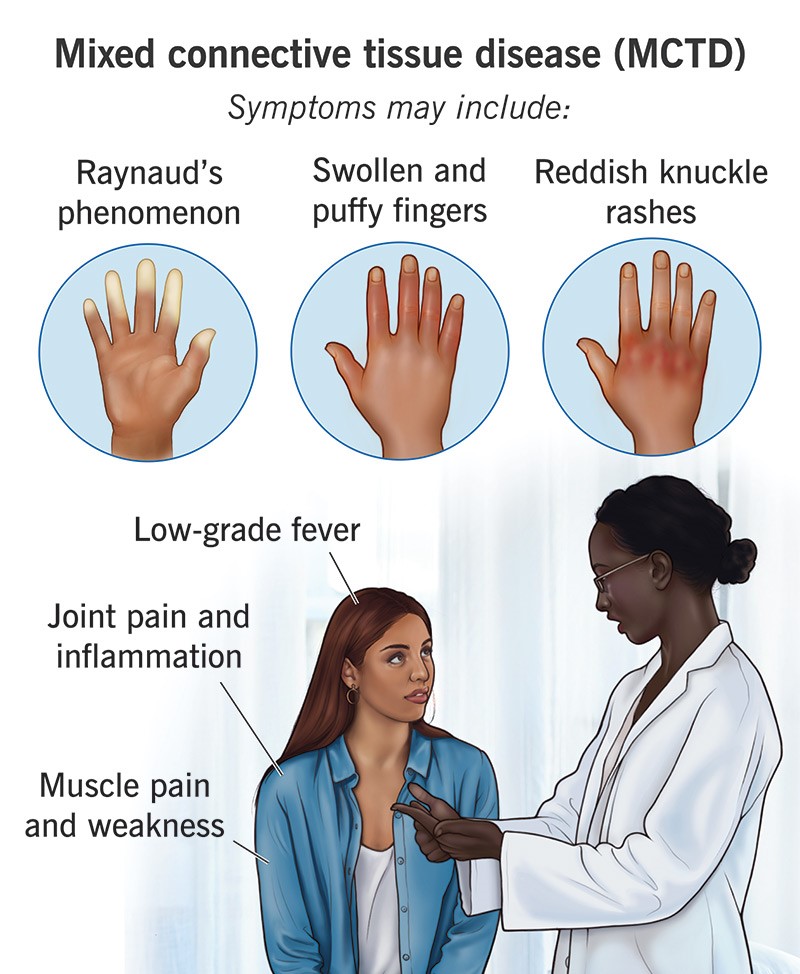 Mixed Connective Tissue Diseases Symptoms